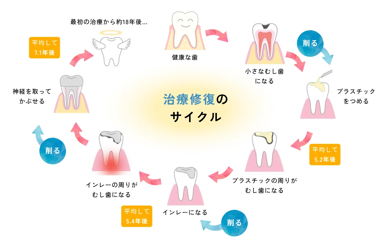 【治療修復のサイクル】健康な歯→小さなむし歯になる（削る）→プラスチックをつめる→プラスチックの周りがむし歯になる→インレーになる（削る）→インレーの周りがむし歯になる（削る）→神経を取ってかぶせる→最初の治療から約18年後…（天使）